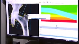 ¿Qué es una densitometría?